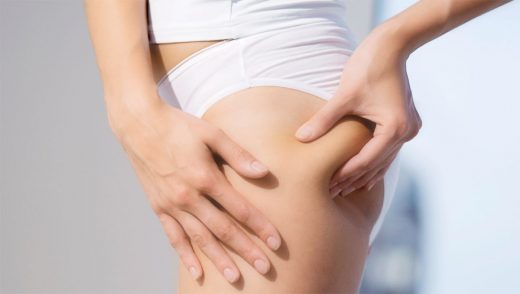 Cellulite